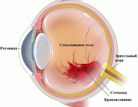 Что делать, если лопнул сосуд в глазу