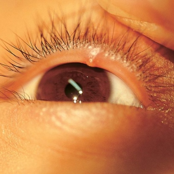Ячмень (гордеолум): причины, симптомы и лечение | Клиника микрохирургии «Глаз» им. С. Федорова