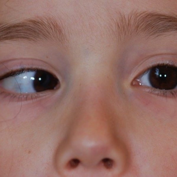 Немного косят глаза. Меланоз склеры гиперметропия. Эзотропия сходящееся косоглазие. Соходашися комоглазие. Косоглазие у детей.