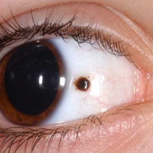 Черные точки в глазах – причины и лечение