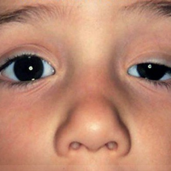 Рота веко. Синдром Маркуса Гунна детей. Птоз верхнего века у ребенка фото. Маркуса Гунна синдром офтальмология.