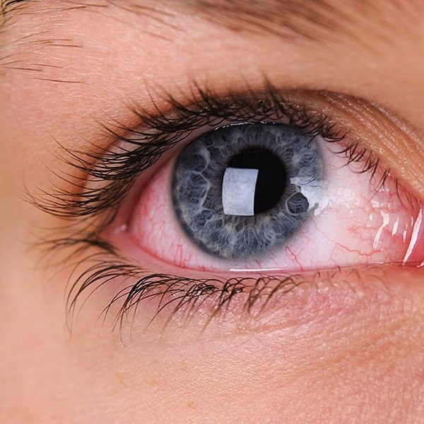 Как избавиться от синдрома сухого глаза в домашних условиях?
