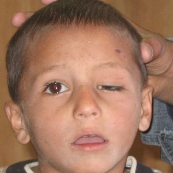 Лечение синдрома Маркуса Гунна