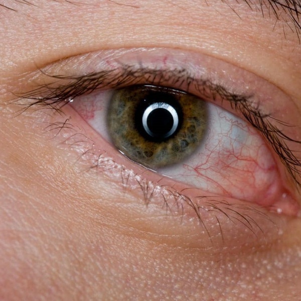 Из-за чего может появиться синдром «сухого глаза»?