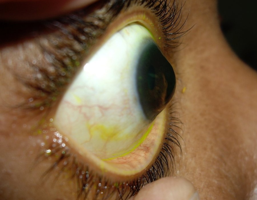 Лечение кератоконуса. Операция при кератоконусе