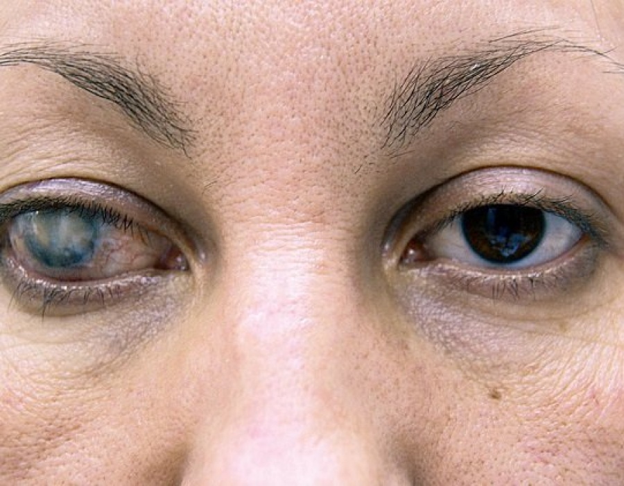 Помутнение роговицы глаза (бельмо): симптомы, признаки и лечение