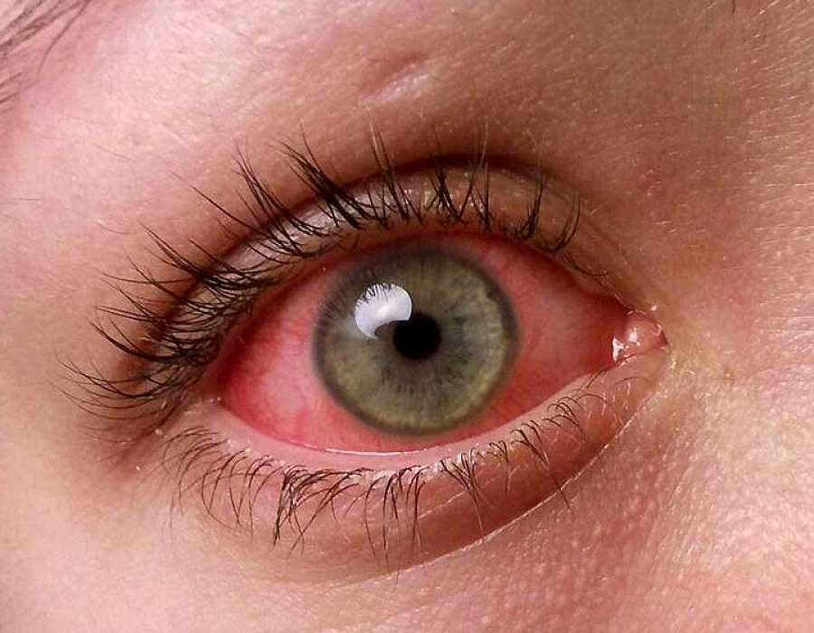 Фурацилин при конъюнктивите - можно ли промывать глаза
