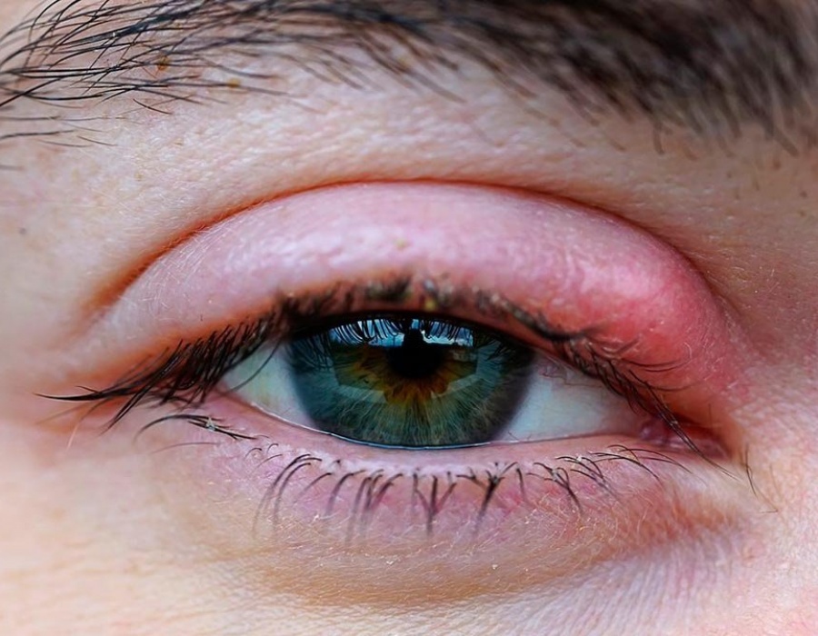 Опухоль глаз после слез