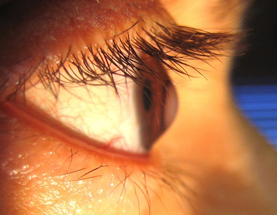 Лечение кератоконуса. Операция при кератоконусе