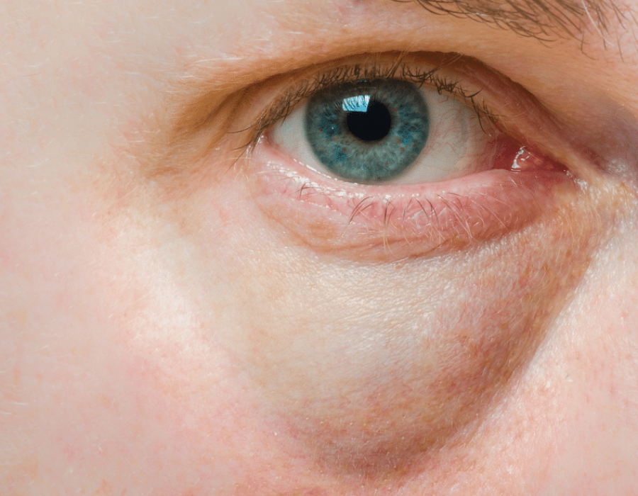 Опухшие глаза: Как избавиться от отеков под глазами
