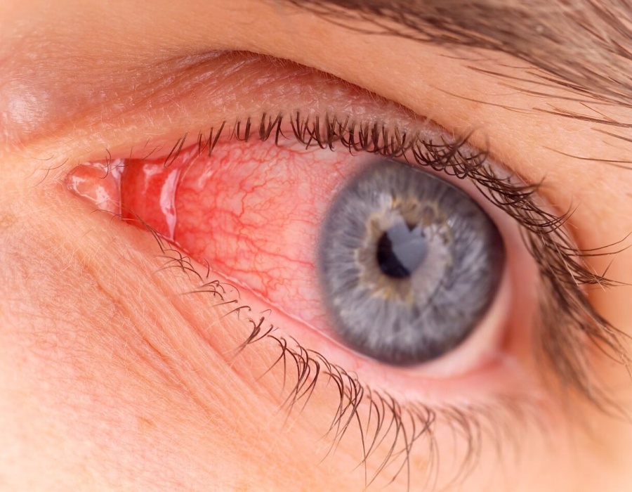 Покраснел глаз и болит - что делать, как лечить
