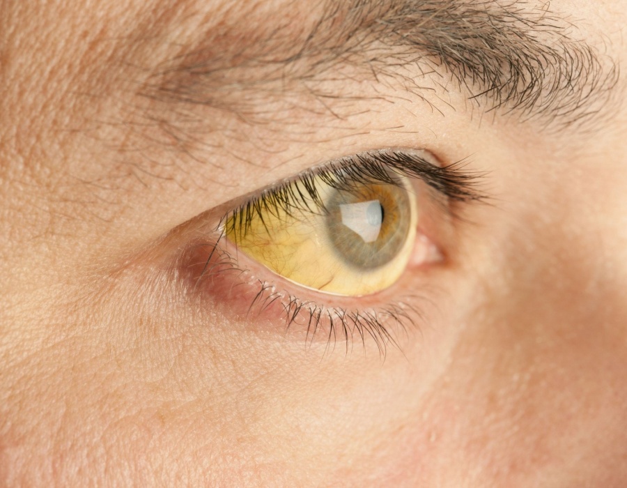 Почему могут быть желтыми белки глаз