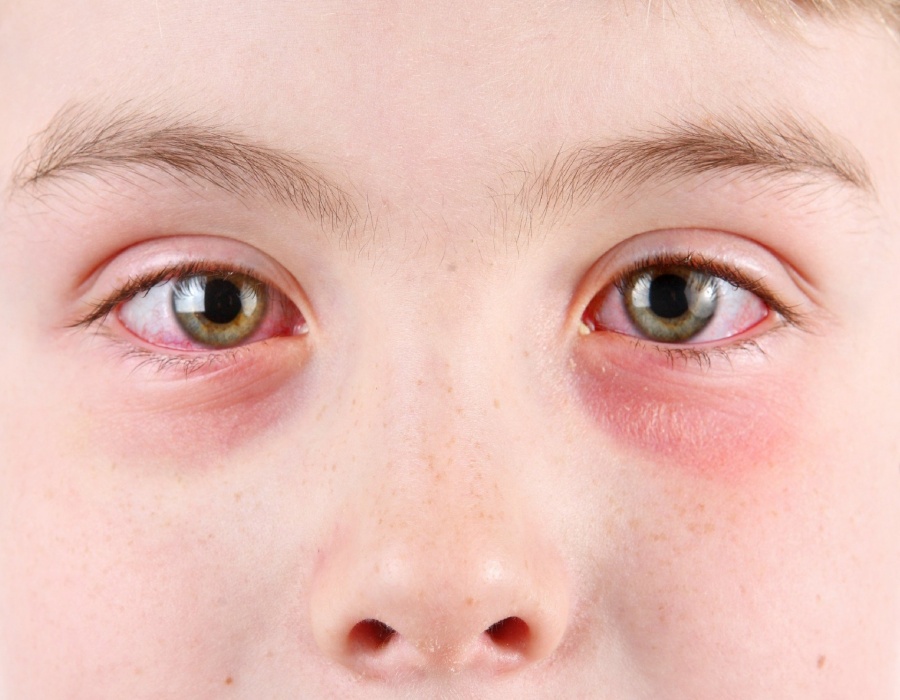 Аллергия на глазах: возможные причины