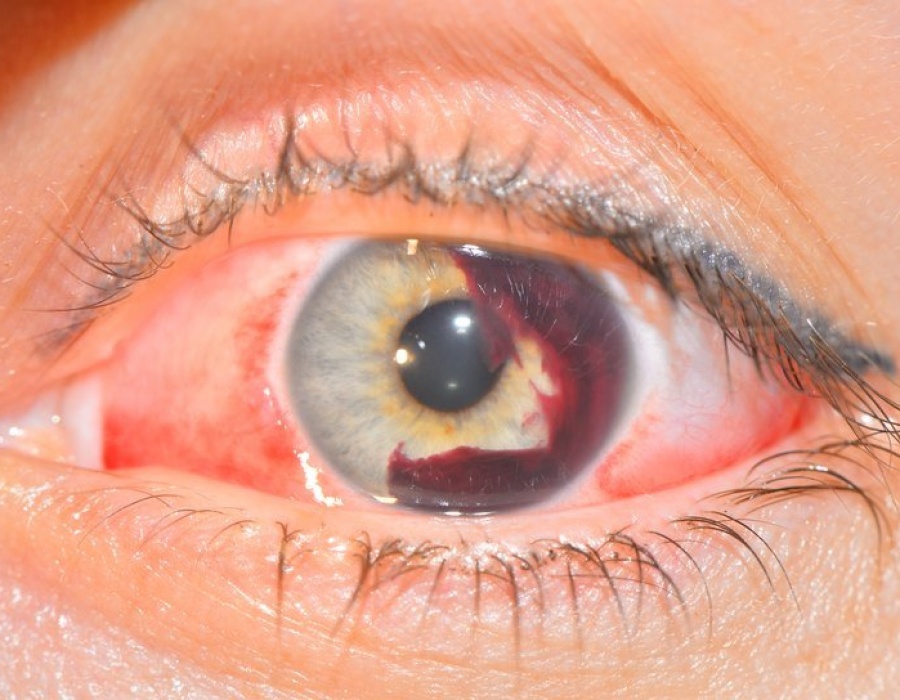 Как ускорить рассасывание крови в глазу?