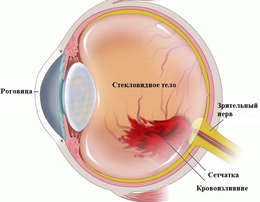 Кровоизлияние в глазу: причины появления и лечение
