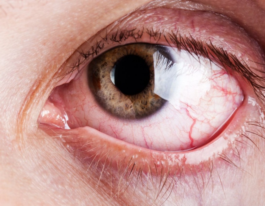 Ожоги, ушибы и травмы глаз: как оказать первую помощь