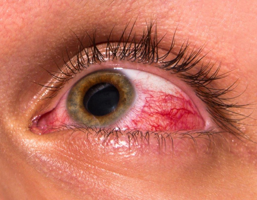 Какие симптомы при повышенном глазном давлении