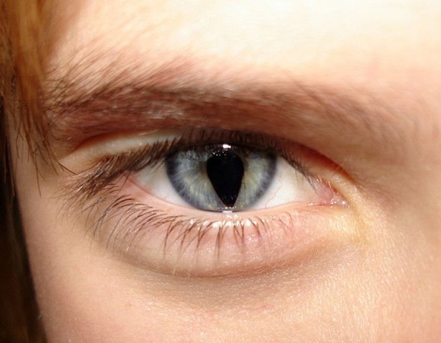 Колобома глаз врожденная и приобретенная